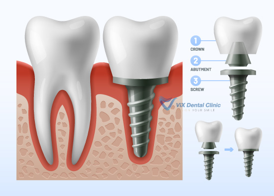 Cấu trúc răng Implant